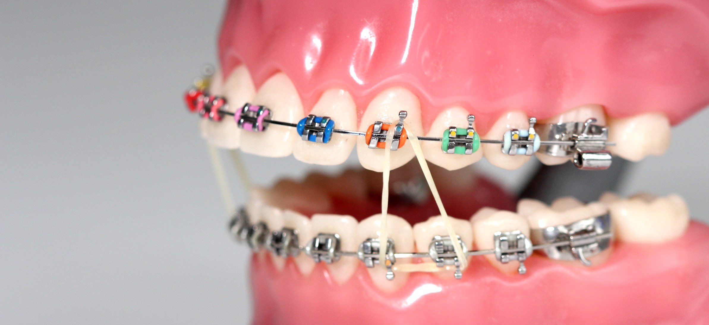 dental elastics